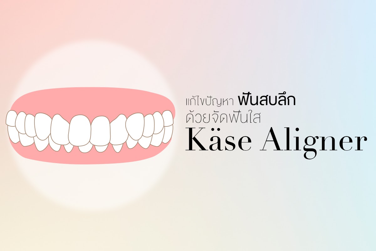 ฟันสบลึก