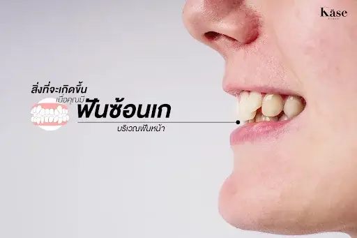 ฟันซ้อนเกบริเวณฟันหน้า