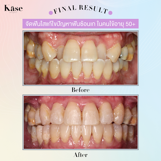 จัดฟันใส Käse Aligner