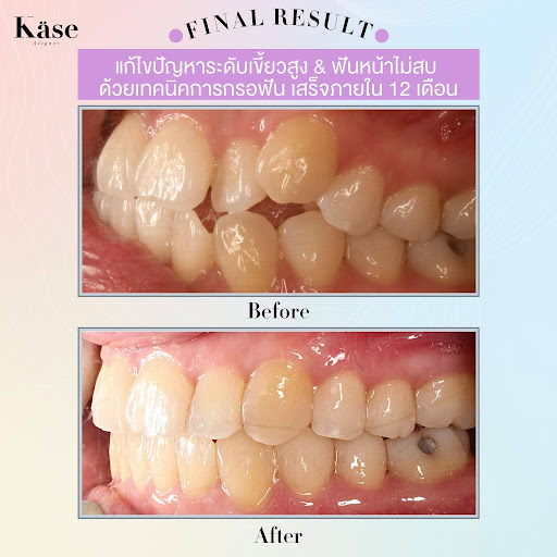  จัดฟันใส Käse Aligner