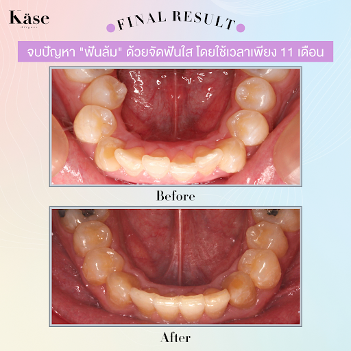 จัดฟันใส Käse Aligner