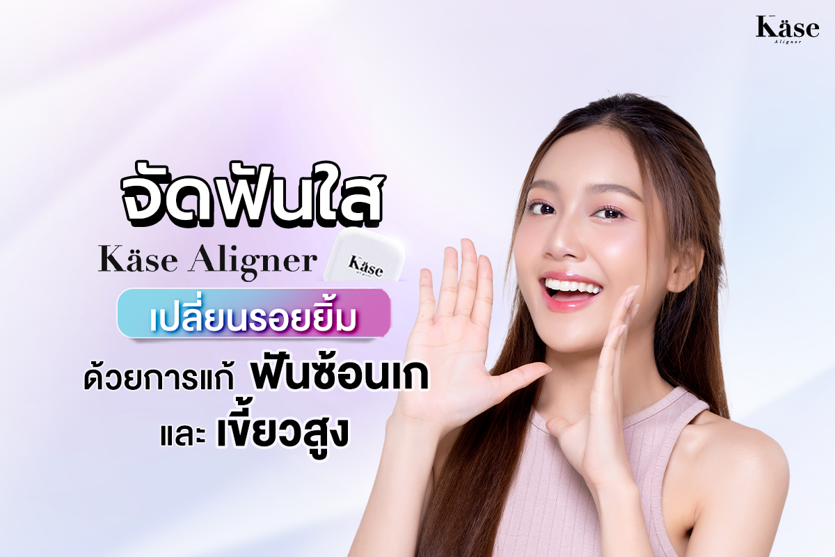 จัดฟันใส Käse Aligner