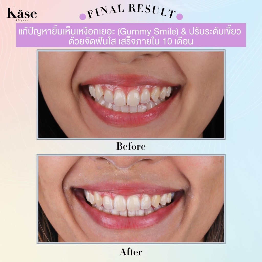 จัดฟันใส Käse Aligner