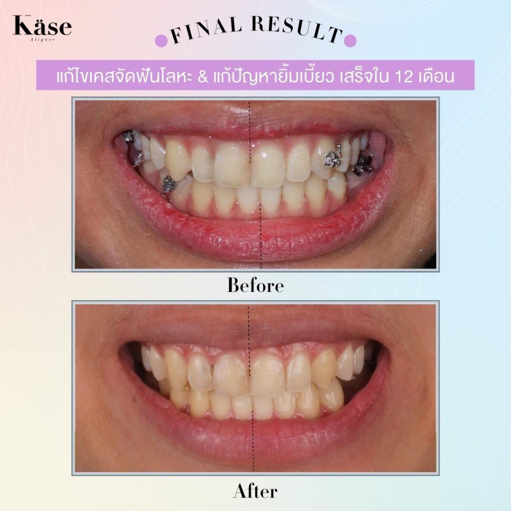 จัดฟันใส Käse Aligner 