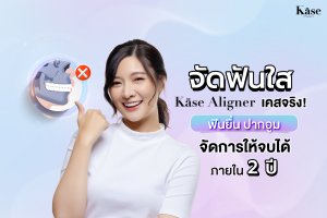 จัดฟันใส Käse Aligner