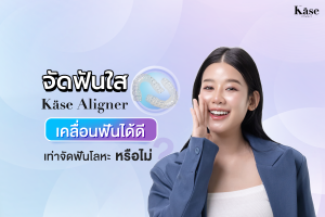 จัดฟันใส Käse Aligner