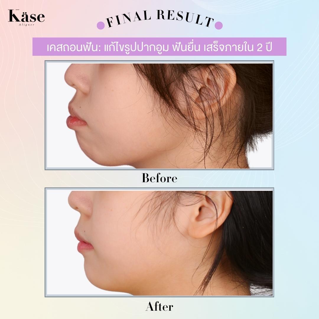 จัดฟันใส Käse Aligner