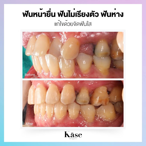 จัดฟันใส