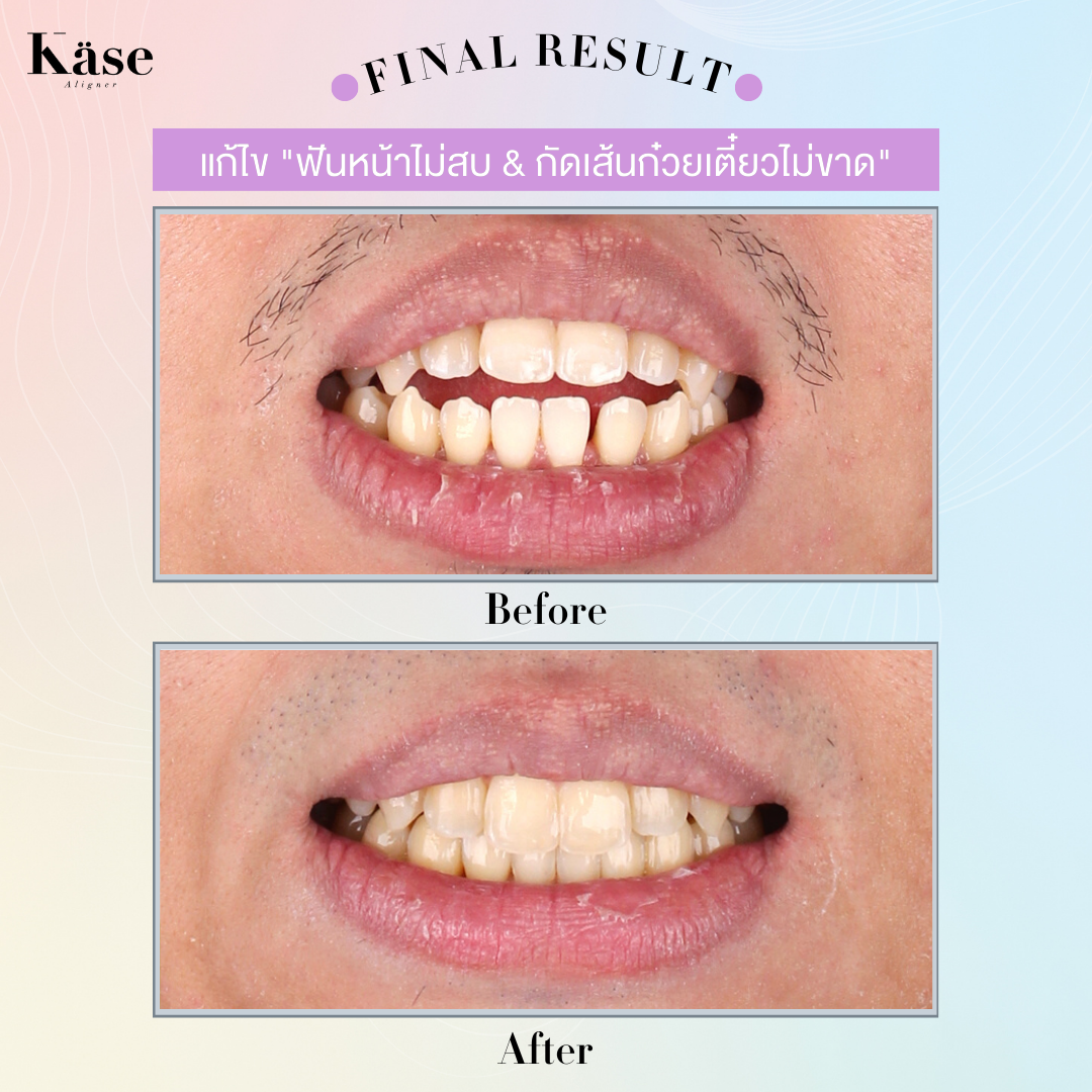 จัดฟันใส Käse Aligner