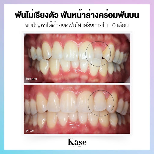 จัดฟันใส ฟันคร่อมสู่ฟันเรียงสวยภายใน 10 เดือน