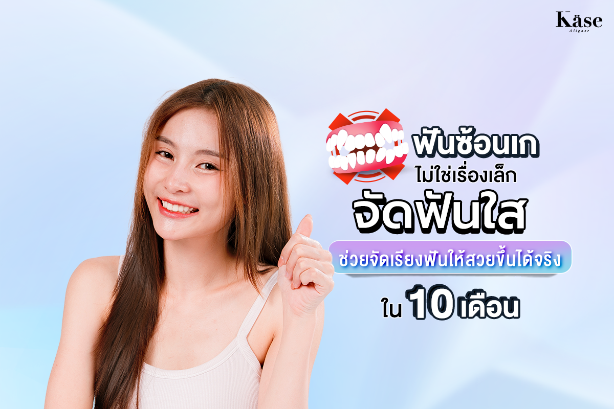จัดฟันใส Käse Aligner