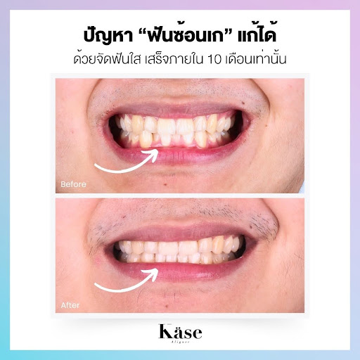 ฟันซ้อนเก