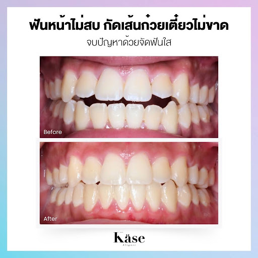 จัดฟันใส Käse Aligner 