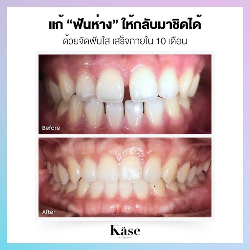 ฟันห่าง