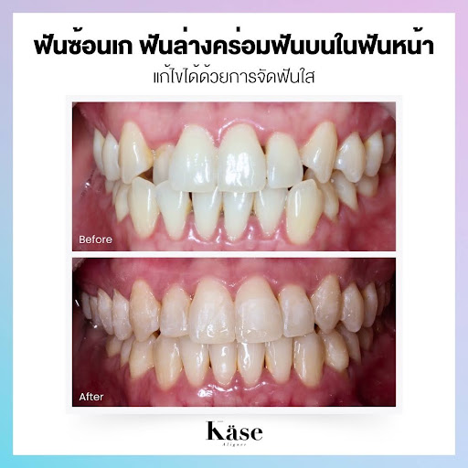 ฟันซ้อนเก