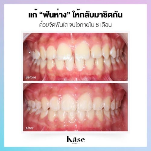 จัดฟันใสแก้ไขฟันห่าง 